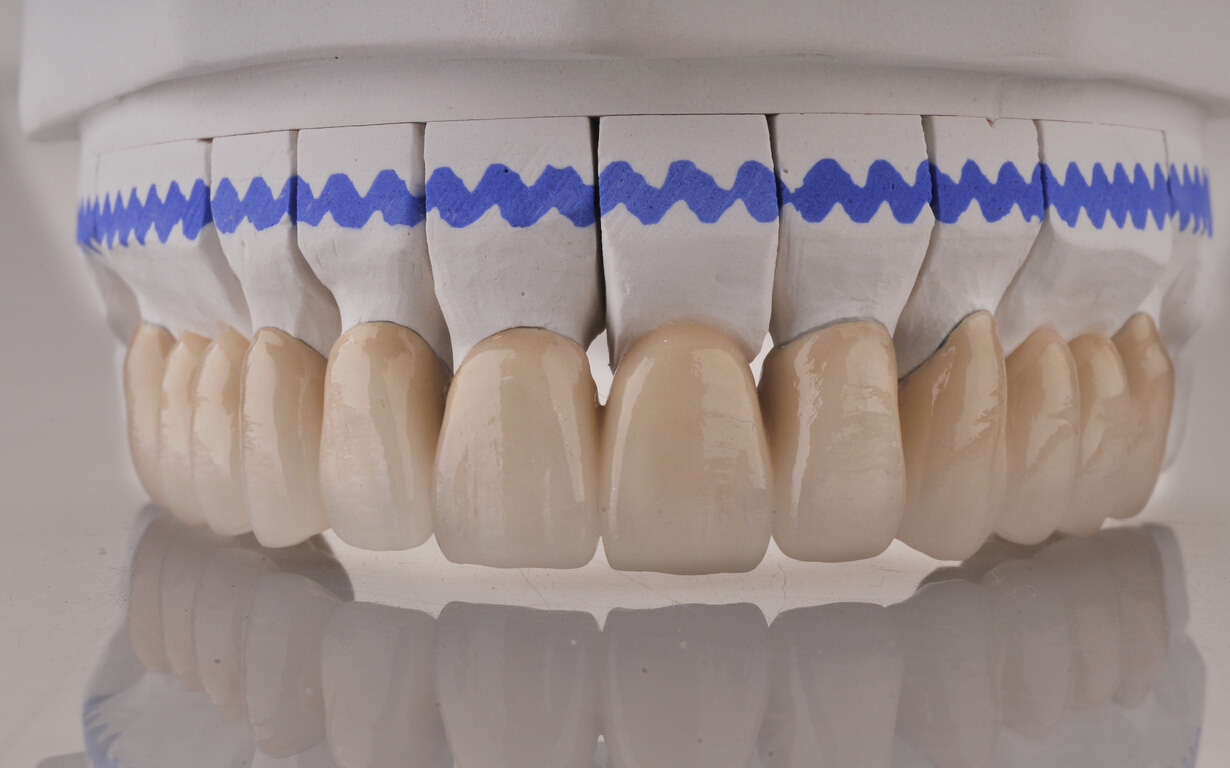 一例上前牙缺失的全瓷牙桥修复 - 知乎