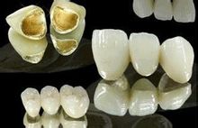 贵金属烤瓷牙 贵金属烤瓷牙