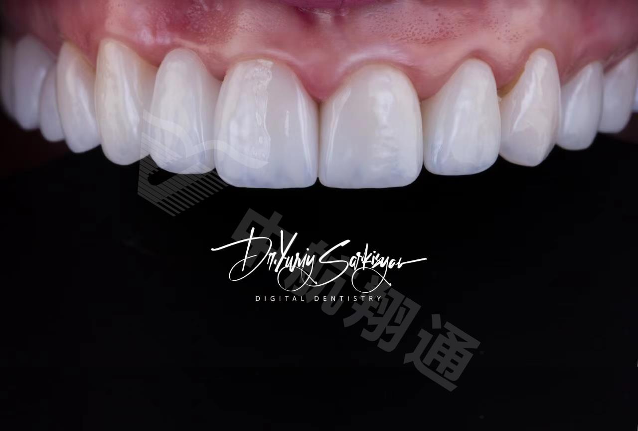 XTCERA 3D White 