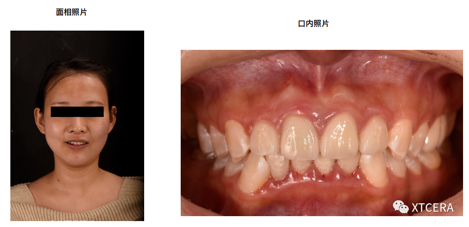 前牙区美学修复临床病例⼀例|全冠修复病例分享（2）