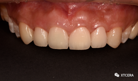 前牙区美学修复临床病例⼀例|全冠修复病例分享（2）