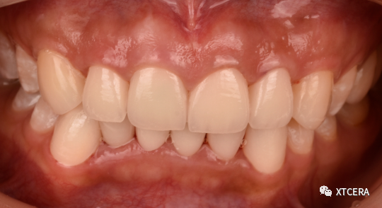 前牙区美学修复临床病例⼀例|全冠修复病例分享（2）