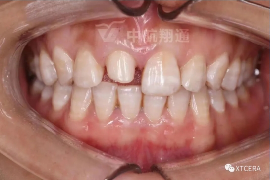 前牙区美学修复一例|全冠修复病例分享