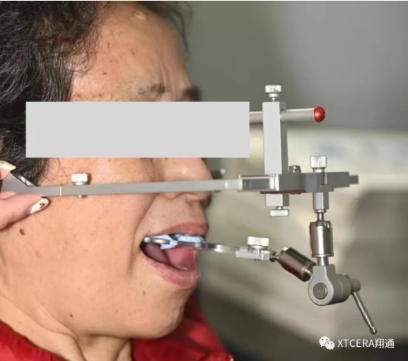 全口氧化锆美学修复临床病例分享