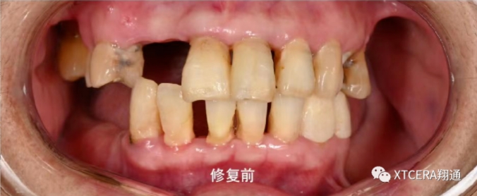 全口氧化锆美学修复临床病例分享