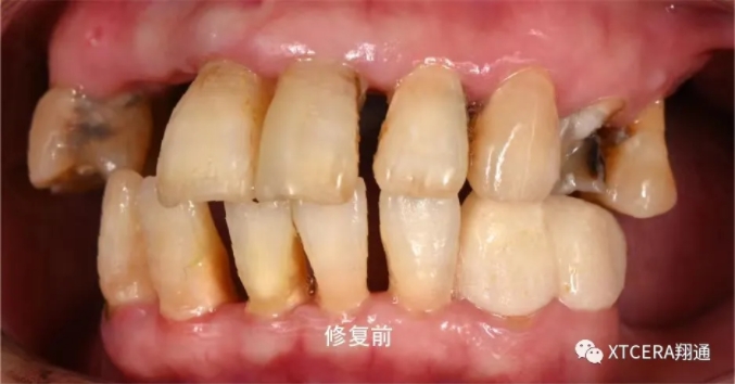 全口氧化锆美学修复临床病例分享