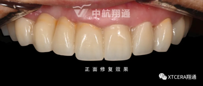 全口氧化锆美学修复临床病例分享