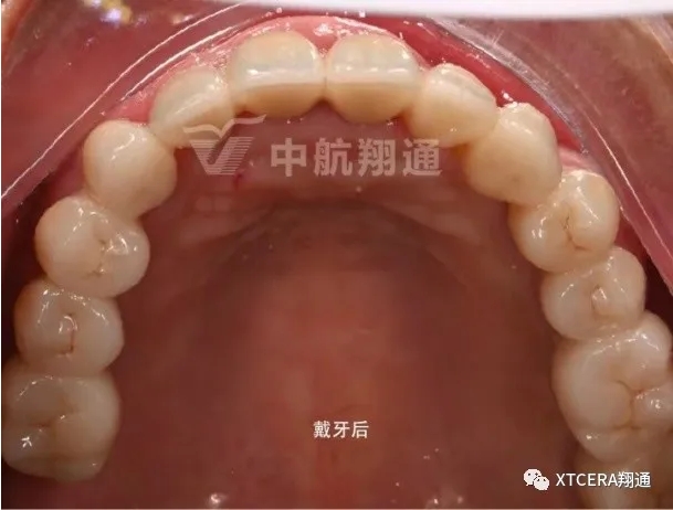 全口氧化锆美学修复临床病例分享