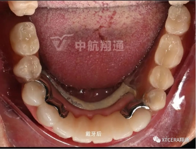 全口氧化锆美学修复临床病例分享