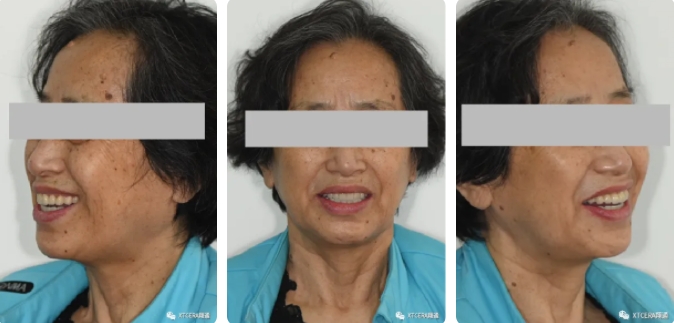 全口氧化锆美学修复临床病例分享