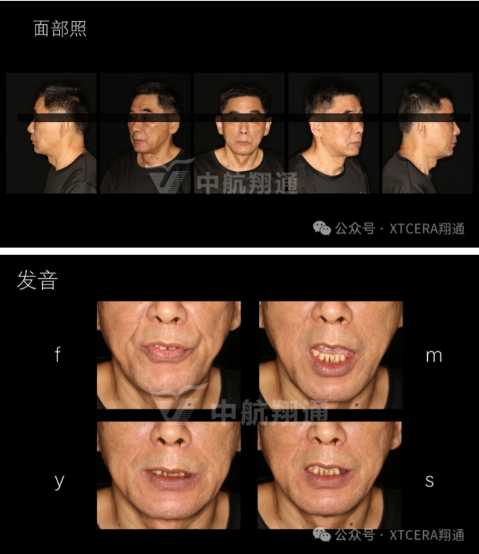 牙周病缺牙患者种植与固定修复一例 牙周病缺牙患者种植与固定修复一例