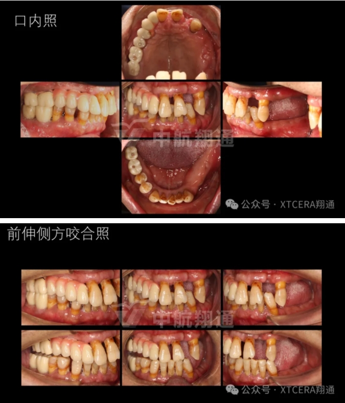 牙周病缺牙患者种植与固定修复一例 牙周病缺牙患者种植与固定修复一例