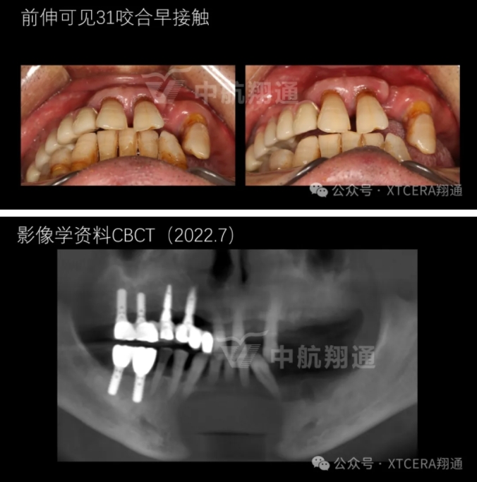 牙周病缺牙患者种植与固定修复一例 牙周病缺牙患者种植与固定修复一例