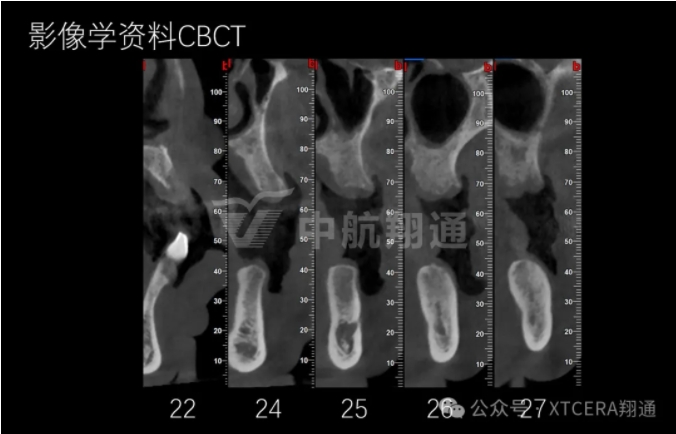 牙周病缺牙患者种植与固定修复一例 牙周病缺牙患者种植与固定修复一例