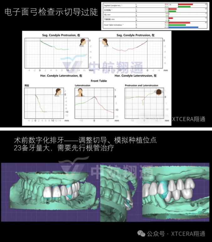 牙周病缺牙患者种植与固定修复一例 牙周病缺牙患者种植与固定修复一例