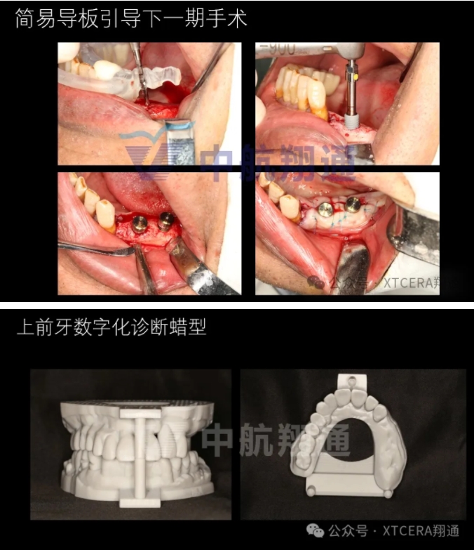 牙周病缺牙患者种植与固定修复一例 牙周病缺牙患者种植与固定修复一例