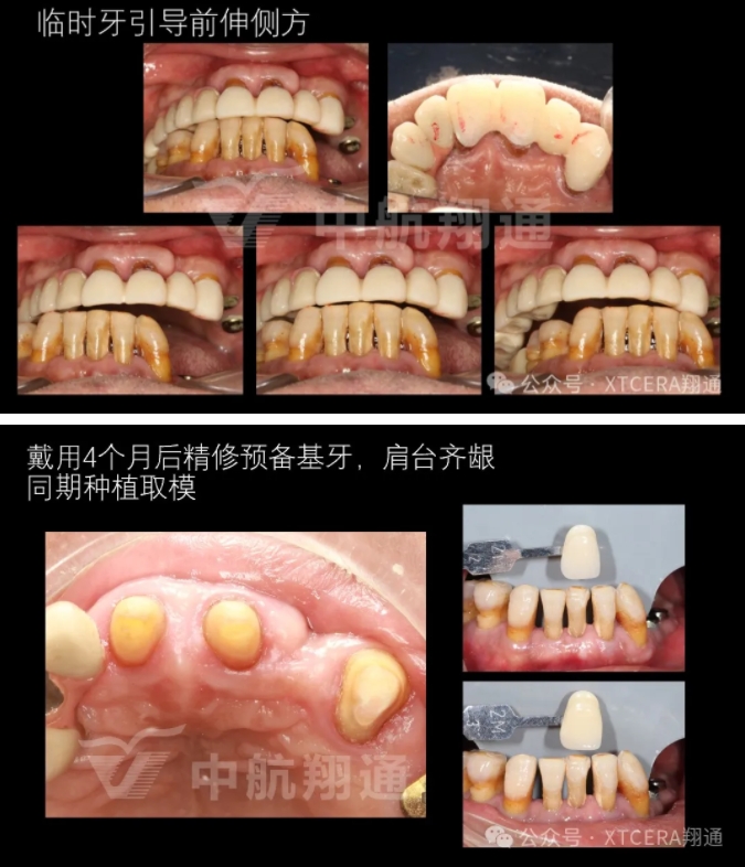 牙周病缺牙患者种植与固定修复一例 牙周病缺牙患者种植与固定修复一例