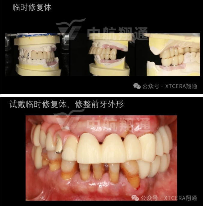 牙周病缺牙患者种植与固定修复一例 牙周病缺牙患者种植与固定修复一例
