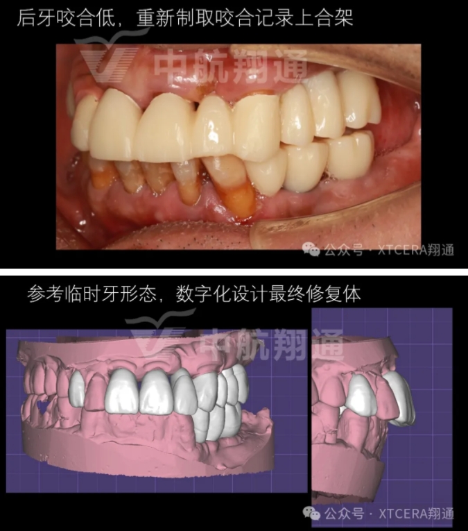 牙周病缺牙患者种植与固定修复一例 牙周病缺牙患者种植与固定修复一例