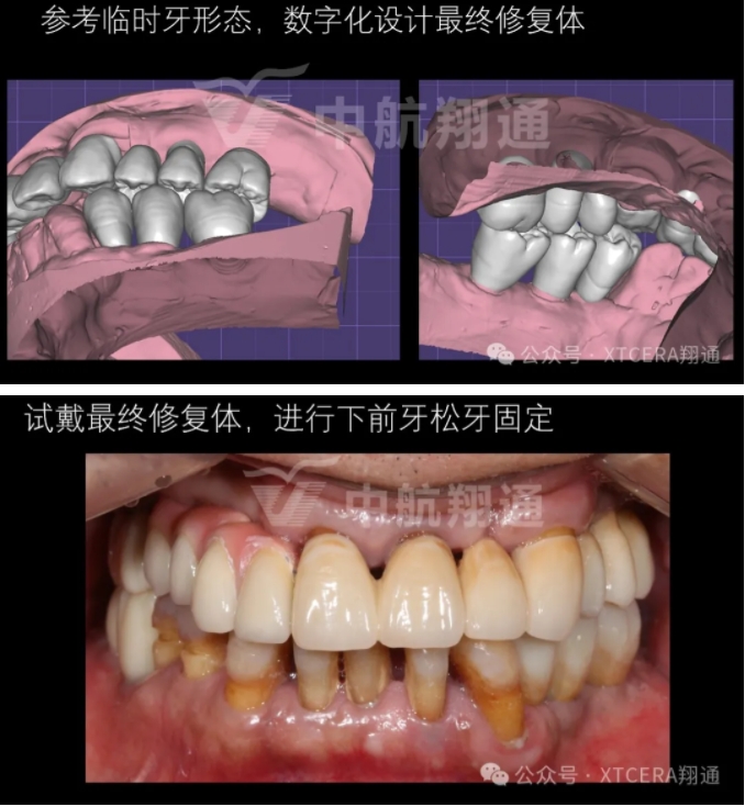 牙周病缺牙患者种植与固定修复一例 牙周病缺牙患者种植与固定修复一例