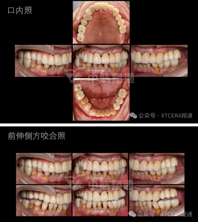 牙周病缺牙患者种植与固定修复一例 牙周病缺牙患者种植与固定修复一例