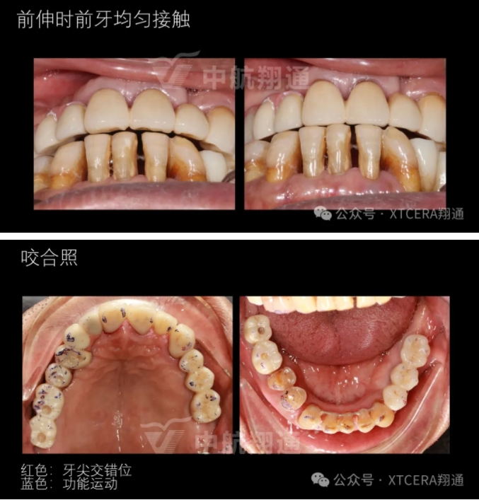 牙周病缺牙患者种植与固定修复一例 牙周病缺牙患者种植与固定修复一例