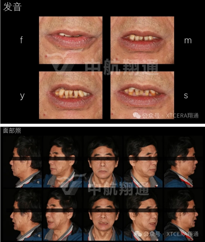 牙周病缺牙患者种植与固定修复一例 牙周病缺牙患者种植与固定修复一例