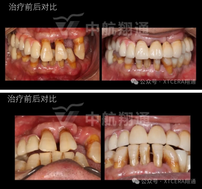牙周病缺牙患者种植与固定修复一例 牙周病缺牙患者种植与固定修复一例