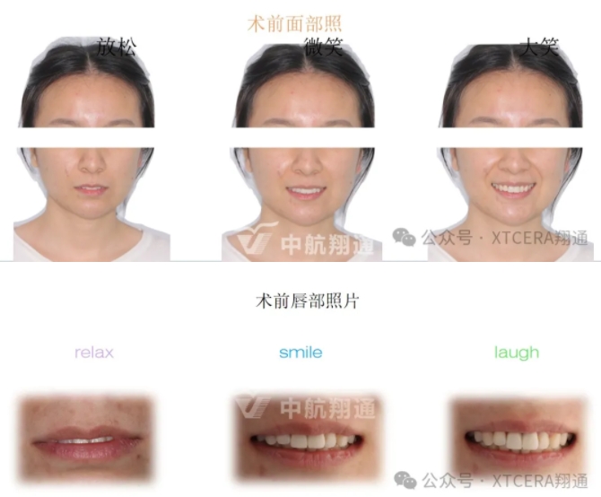 前牙再修复一例|AL-star恒星美学修复 前牙再修复一例|AL-star恒星美学修复