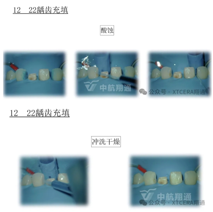 前牙再修复一例|AL-star恒星美学修复 前牙再修复一例|AL-star恒星美学修复