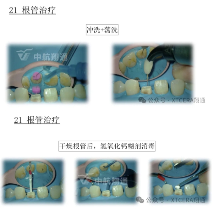 前牙再修复一例|AL-star恒星美学修复 前牙再修复一例|AL-star恒星美学修复
