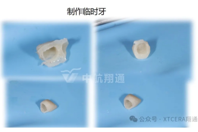前牙再修复一例|AL-star恒星美学修复 前牙再修复一例|AL-star恒星美学修复
