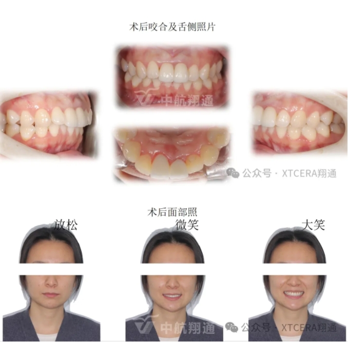 前牙再修复一例|AL-star恒星美学修复 前牙再修复一例|AL-star恒星美学修复
