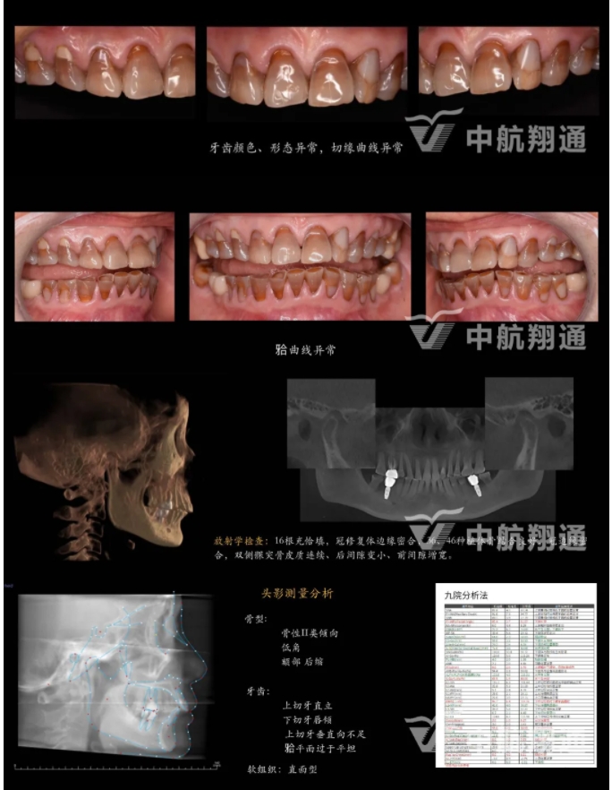 多学科联合治疗重度磨耗咬合重建⼀例
