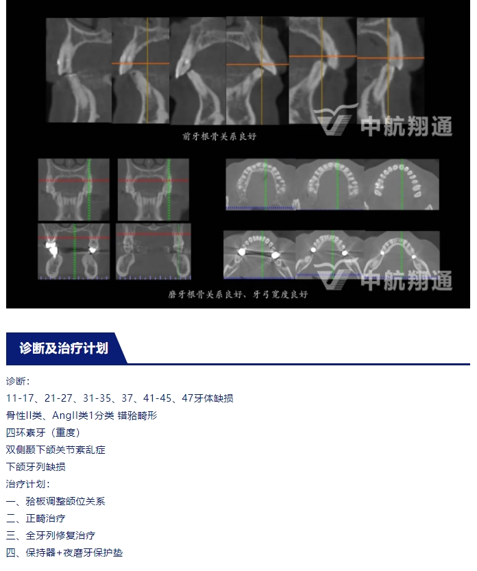 多学科联合治疗重度磨耗咬合重建⼀例