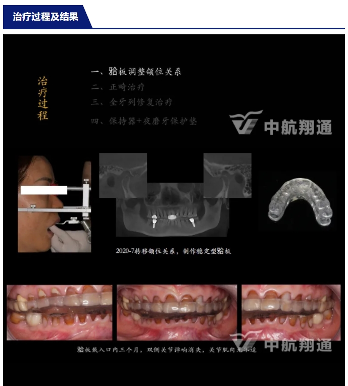 多学科联合治疗重度磨耗咬合重建⼀例