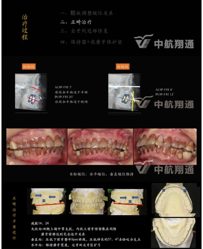 多学科联合治疗重度磨耗咬合重建⼀例