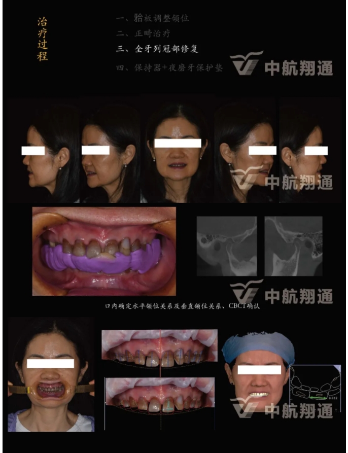 多学科联合治疗重度磨耗咬合重建⼀例