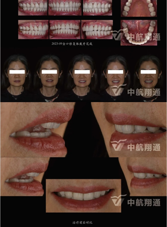 多学科联合治疗重度磨耗咬合重建⼀例