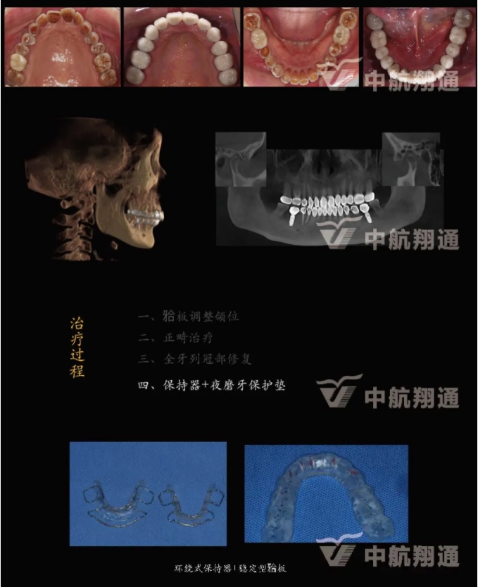 多学科联合治疗重度磨耗咬合重建⼀例