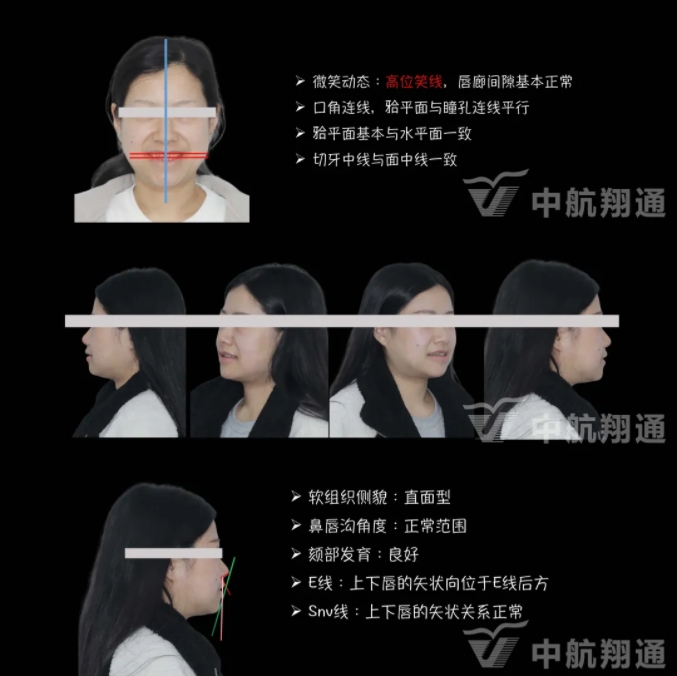 2024华人美学临床病例大赛获奖病例|数字化辅助牙列重度磨耗的美学和功能重建一例