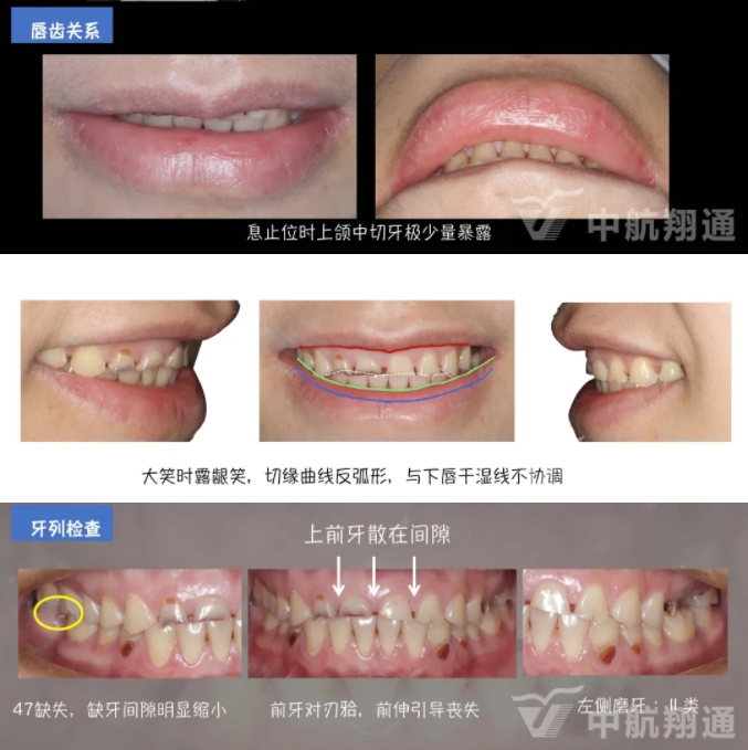 2024华人美学临床病例大赛获奖病例|数字化辅助牙列重度磨耗的美学和功能重建一例