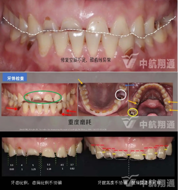 2024华人美学临床病例大赛获奖病例|数字化辅助牙列重度磨耗的美学和功能重建一例