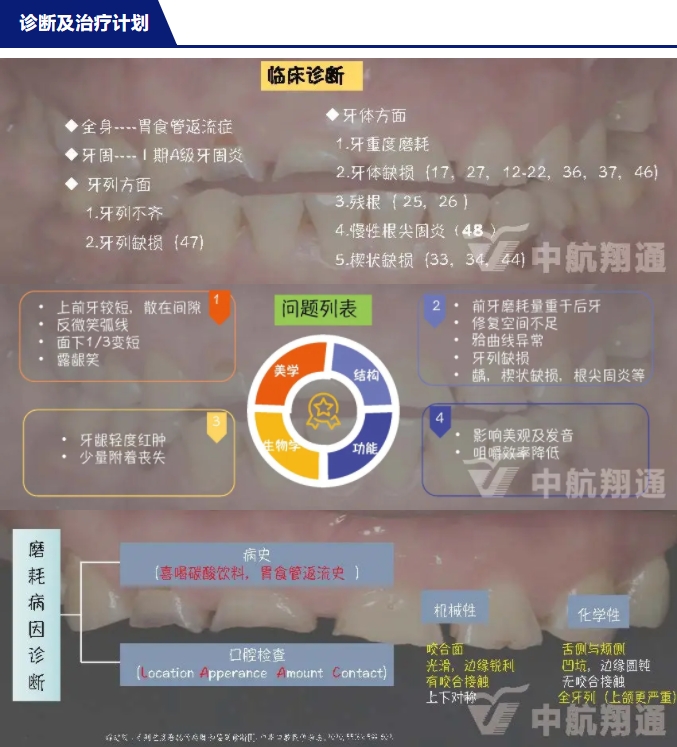 2024华人美学临床病例大赛获奖病例|数字化辅助牙列重度磨耗的美学和功能重建一例