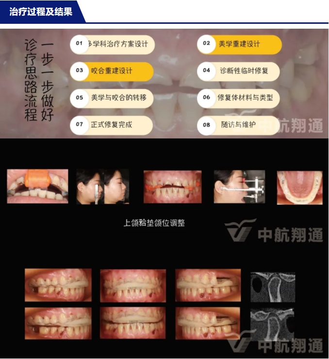 2024华人美学临床病例大赛获奖病例|数字化辅助牙列重度磨耗的美学和功能重建一例