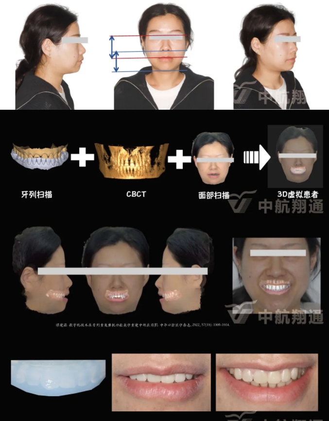 2024华人美学临床病例大赛获奖病例|数字化辅助牙列重度磨耗的美学和功能重建一例