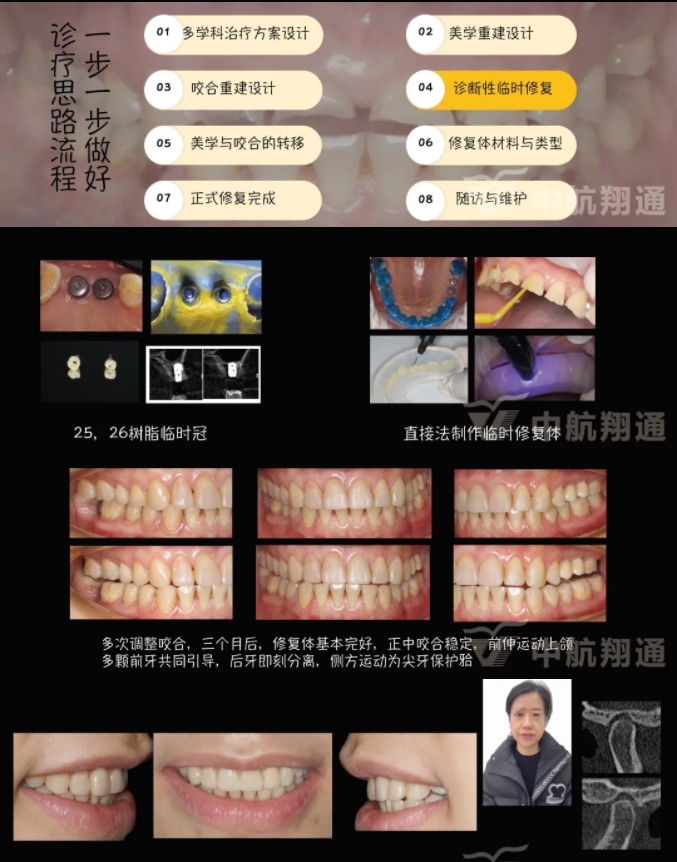 2024华人美学临床病例大赛获奖病例|数字化辅助牙列重度磨耗的美学和功能重建一例