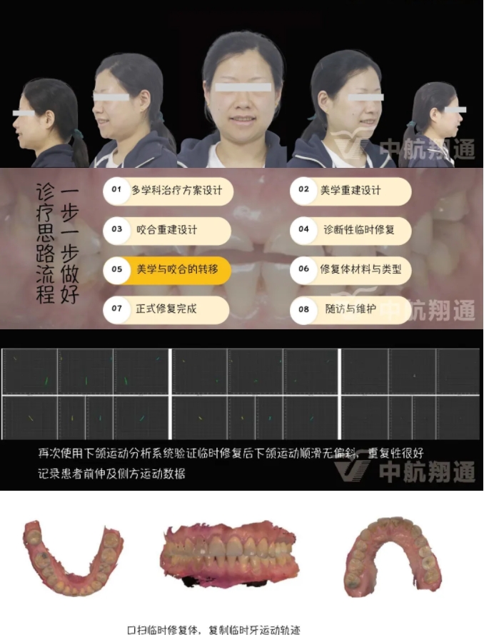 2024华人美学临床病例大赛获奖病例|数字化辅助牙列重度磨耗的美学和功能重建一例