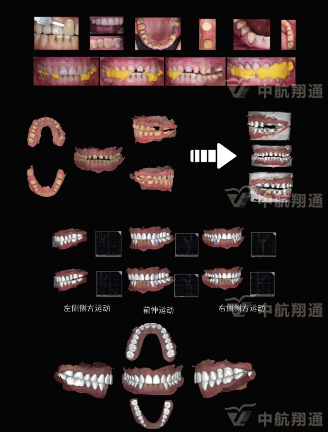 2024华人美学临床病例大赛获奖病例|数字化辅助牙列重度磨耗的美学和功能重建一例