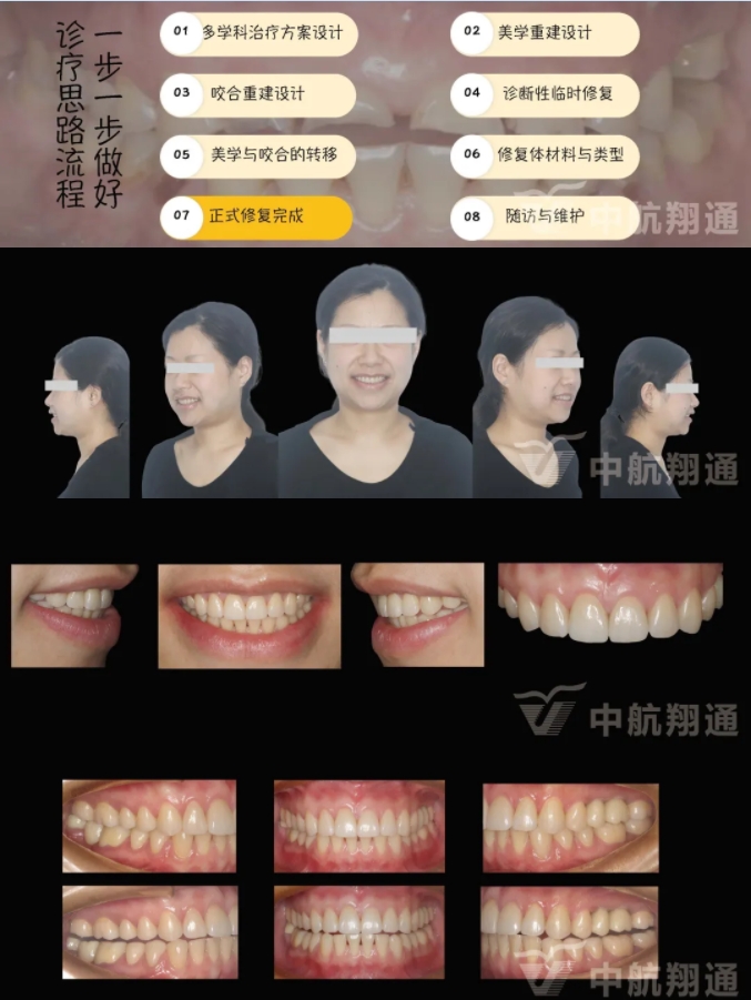 2024华人美学临床病例大赛获奖病例|数字化辅助牙列重度磨耗的美学和功能重建一例